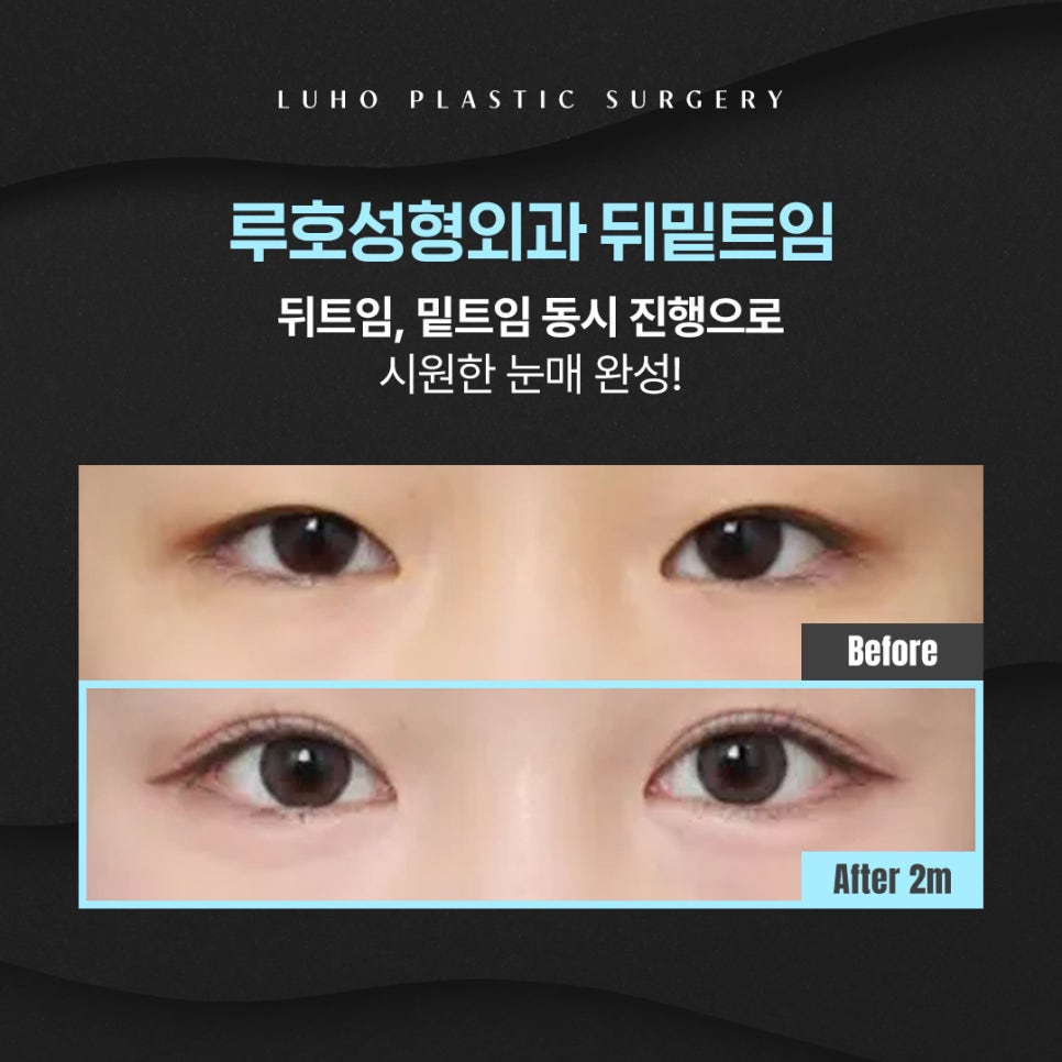 Review of Lateral and Lower Canthoplasty for Opening Up a Tight-Looking Eye Shape image 1