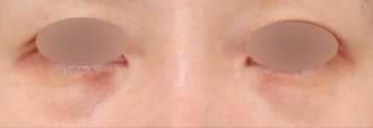 Before and After Undereye Fat Repositioning at Sinsa Station: Why the Undereye Appearance Changed image 2