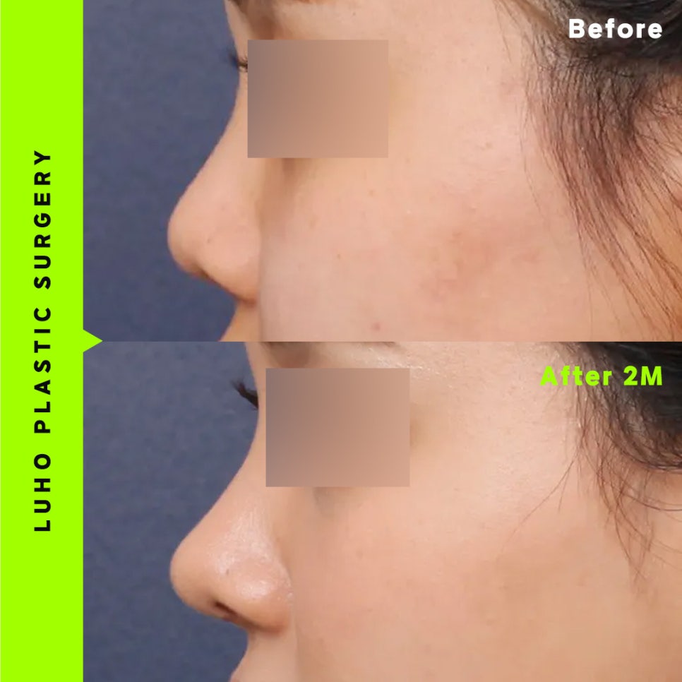 How to Address a Button Nose Based on a Surgery Review from Sinsa Station image 1