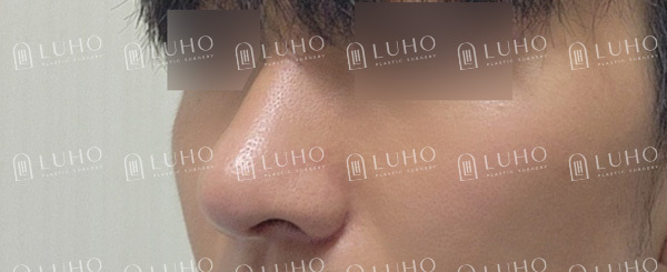 복코와 콧볼을 정리한 남자코수술, 어떤 부분이 바뀌었을까? 관련 이미지 10