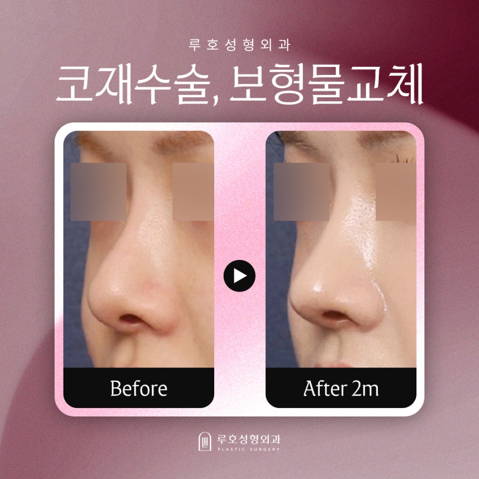 신사역 코 성형 재수술, 보형물 교체로 인위적인 콧대 개선 관련 이미지 1
