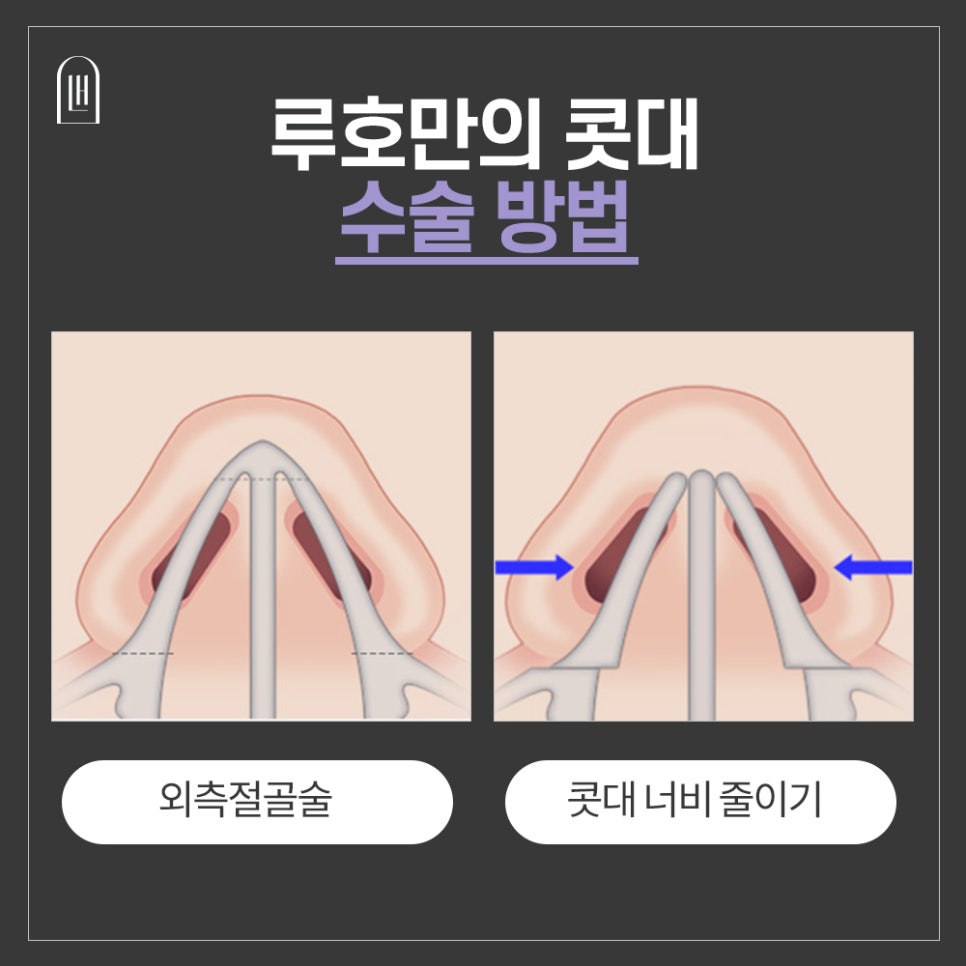 넓은 콧대,이제는 슬림하고 세련되게! 관련 이미지 5