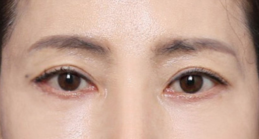 Real Patient Review: Eye-Corner Thread Lifting for a More Open, Defined Look image 5