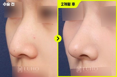 Non-Implant Rhinoplasty at Luho Plastic Surgery near Sinsa Station image 4