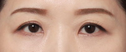 눈밑볼록, 신사역 눈밑지방재배치 받은 후기 관련 이미지 4