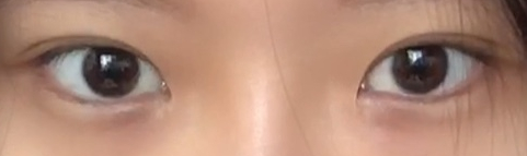 How Double Eyelid Surgery at Sinsa Station Changed the Appearance of the Eyes: A Look at Before-and-After Photos image 4
