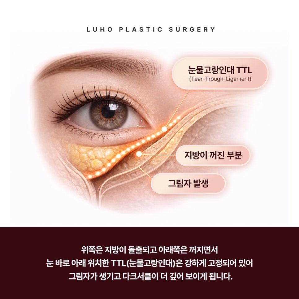 눈밑지방재배치, 다크서클도 사라지나요? Q&A 관련 이미지 3