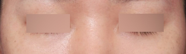 Review of Improvement to a Smooth Under-Eye Area at a Sinsa Station Under-Eye Surgery Clinic image 5