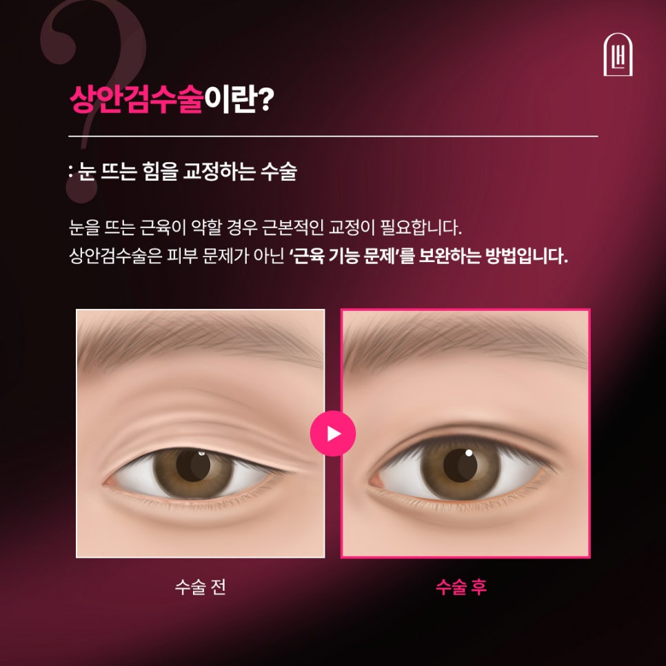 피곤해 보이는 눈매를 바꾼 상안검 수술 후기 관련 이미지 2