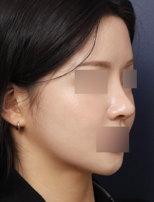 신사역 코 성형 재수술, 보형물 교체로 인위적인 콧대 개선 관련 이미지 4