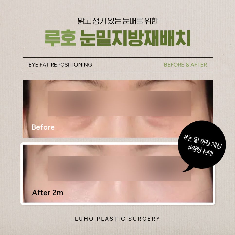 눈 밑 꺼짐을 개선하고 환하게 변한 신사역 눈밑지 전후 비교 관련 이미지 1