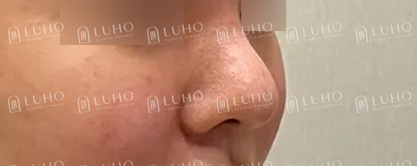 Redesigning a Bulbous Nose After 9 Years: Revision Rhinoplasty image 3