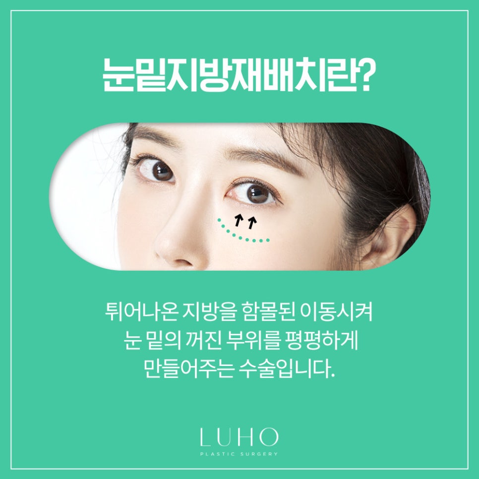 눈밑지방재배치로 환해지고 밝아진 얼굴로 관련 이미지 2