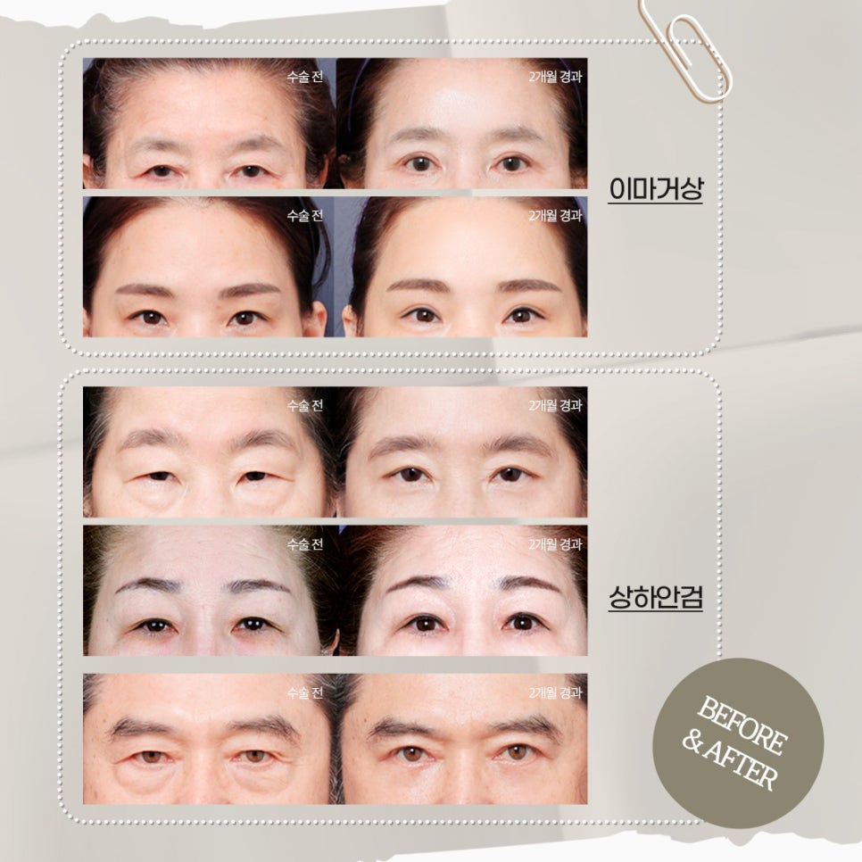 노안의 원인은 바로 관련 이미지 3