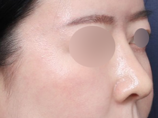 A Real Sinsa Station Rhinoplasty Case That Created a Harmonious Face image 5