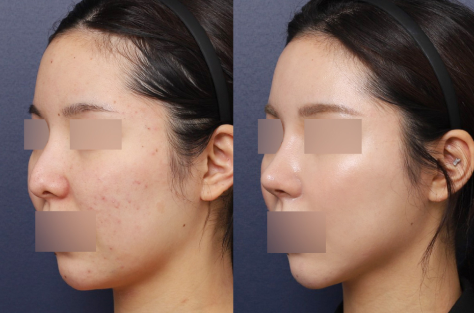 Apgujeong Station Low Nose Surgery: How to Naturally Increase the Bridge of the Nose image 2