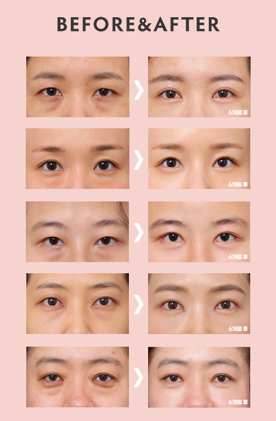 ［루호성형외과］어두운 눈 밑을 환하게-눈밑지방재배치 관련 이미지 13