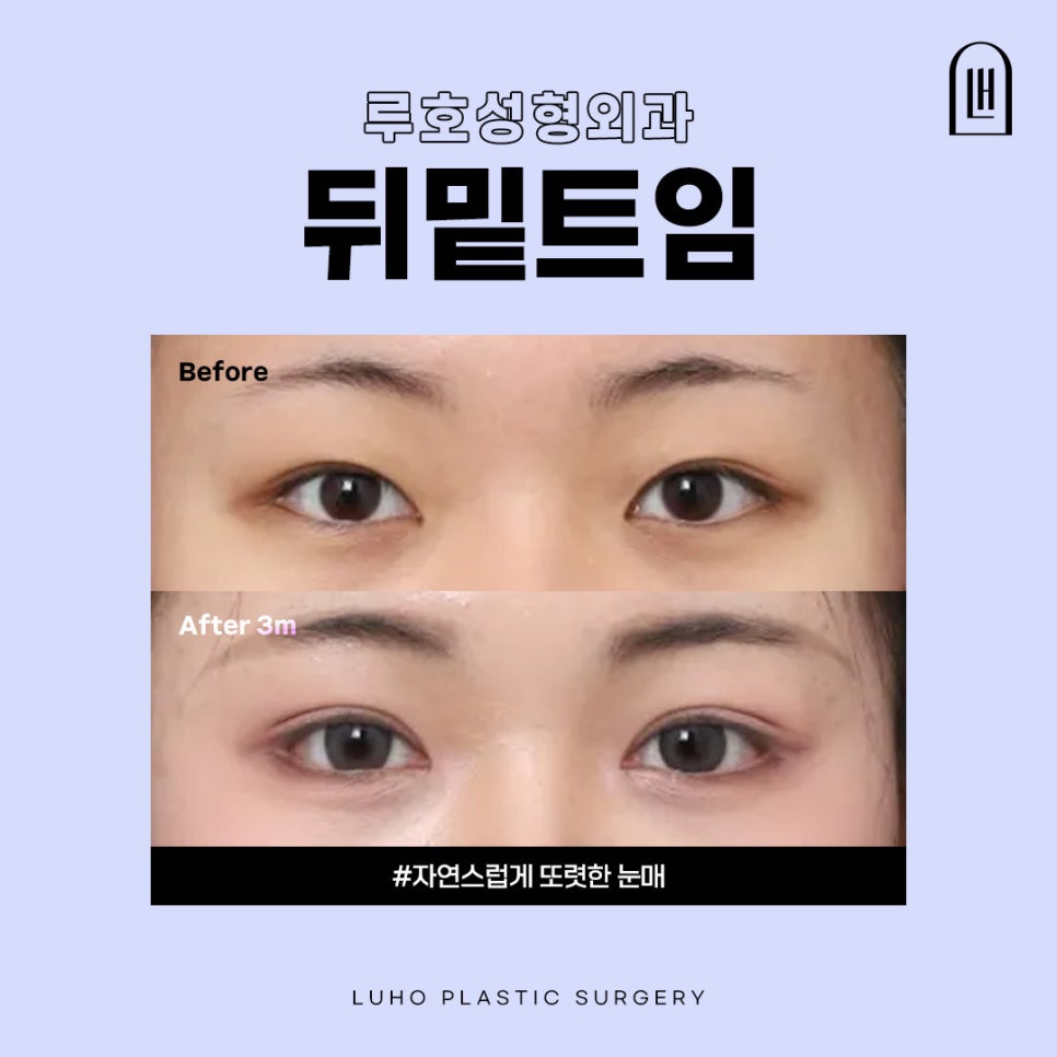 답답한 눈매 개선, 신사역 뒤밑트임 후기 관련 이미지 1