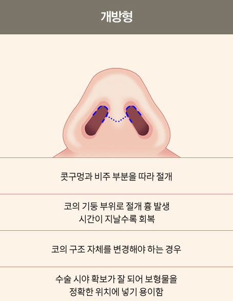 Sinsa Station Nose Plastic Surgery Clinic, Open vs. Closed Nose Surgery image 3