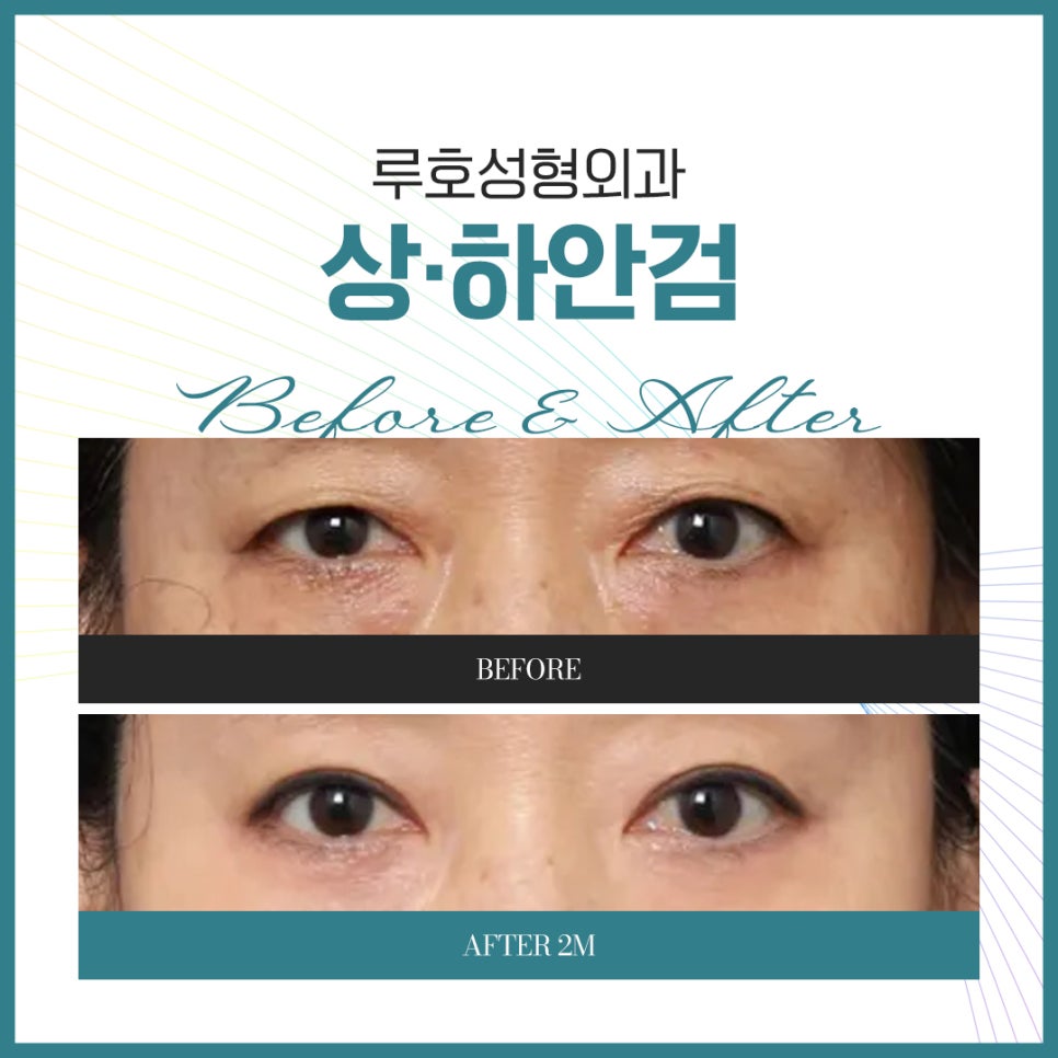 A Look at How Middle-Aged Eye Surgery at Sinsa Station Changes the Eye Shape image 1