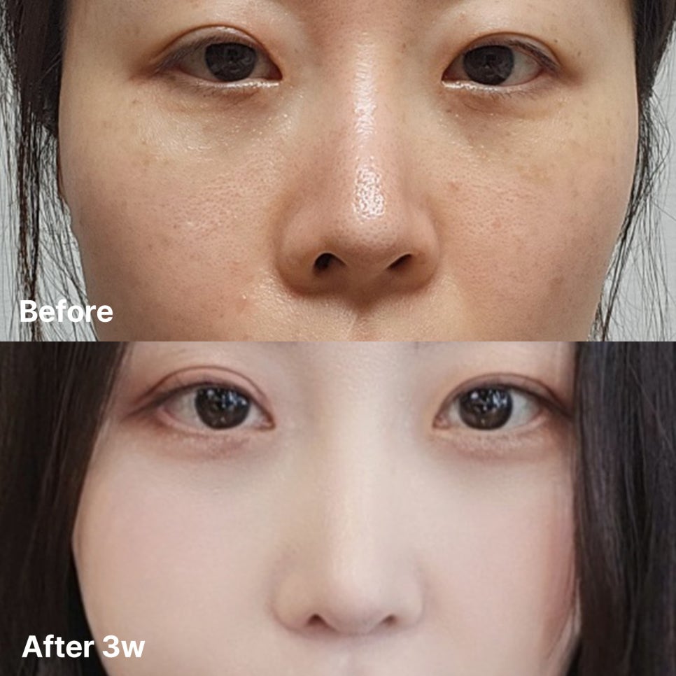 A Review of Eye & Nose Revision Surgery That Addressed the Shortcomings of Previous Surgery image 1