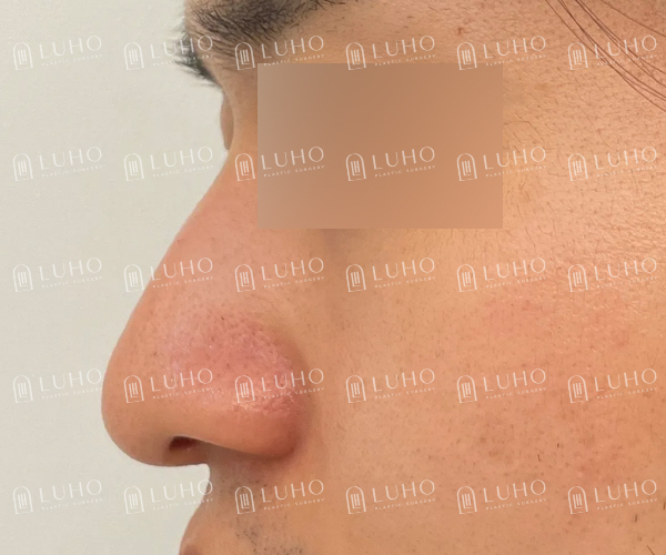 코 필러 후에도 고민이 남은 코라인 개선한 남자 코재수술 관련 이미지 3
