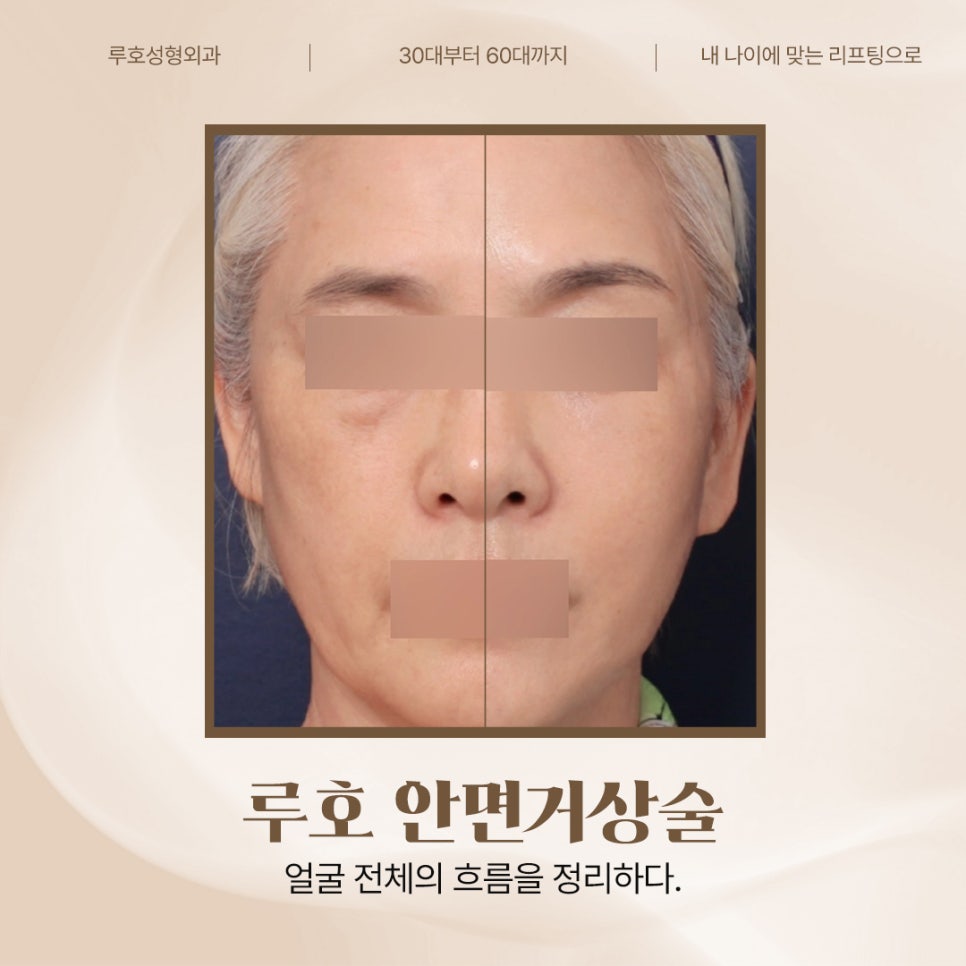 얼굴 전체 흐름이 정리된 신사역 안면거상술 후기 관련 이미지 1