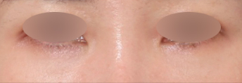 Before and After Undereye Fat Repositioning at Sinsa Station: Why the Undereye Appearance Changed image 5