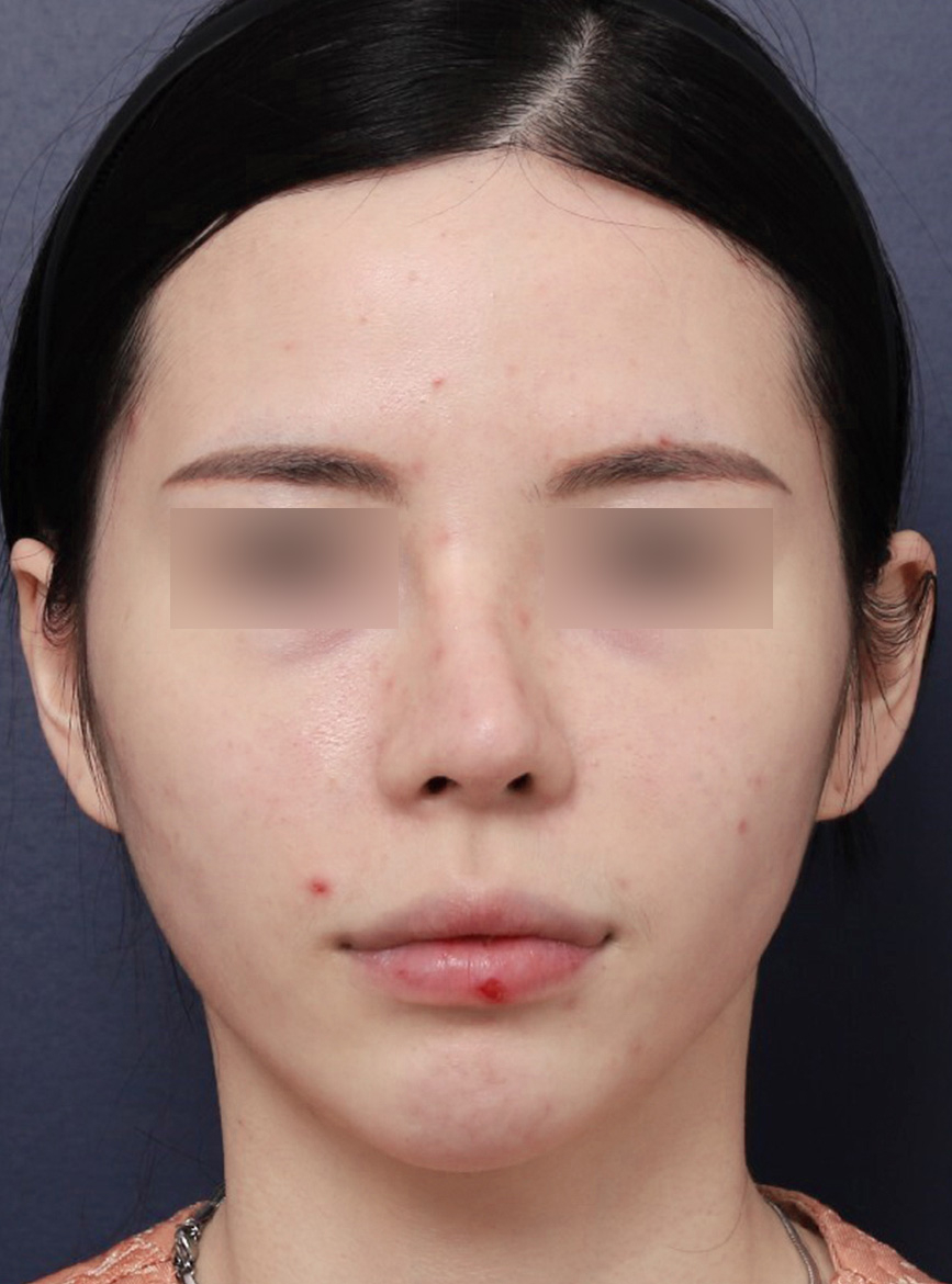 휘어진 코를 바르게 신사역 휜코수술 후기 관련 이미지 4