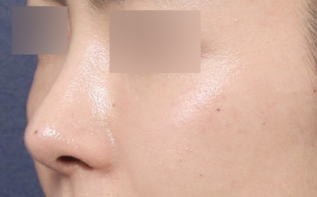 A Rhinoplasty Review for the Nasal Tip at Sinsa Station That Changed a Blurry Impression image 6