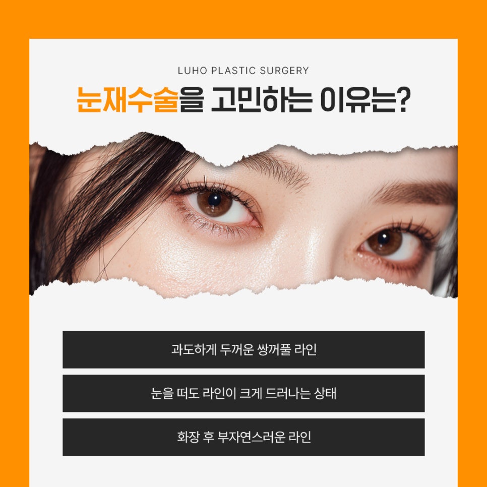 소시지 눈 재수술로 자연스럽고 또렷해진 눈매 관련 이미지 2
