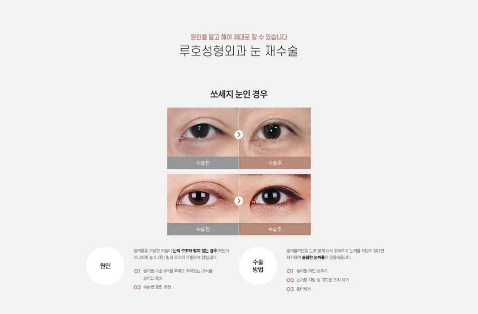 눈 수술법의 종류와 회복기간 #2 관련 이미지 7