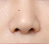 Changed Facial Appearance Through Arrow Nose Surgery at Sinsa Station image 5