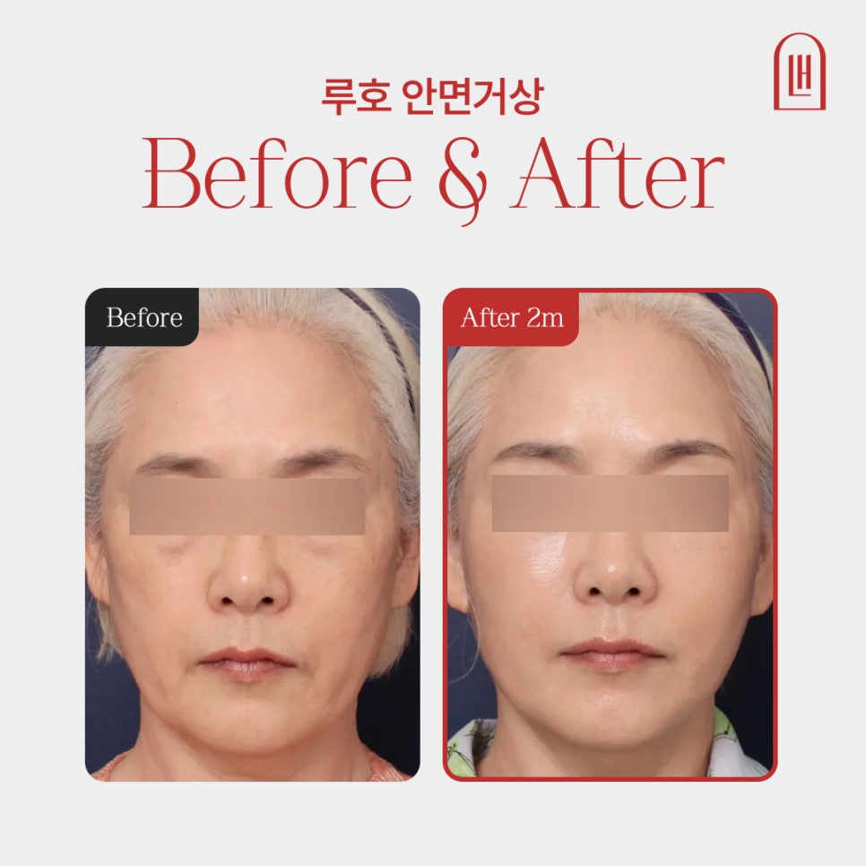 마리오네트 주름 해결한 신사역 안면거상술 효과 관련 이미지 1