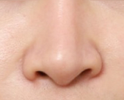 Changed Facial Appearance Through Arrow Nose Surgery at Sinsa Station image 3