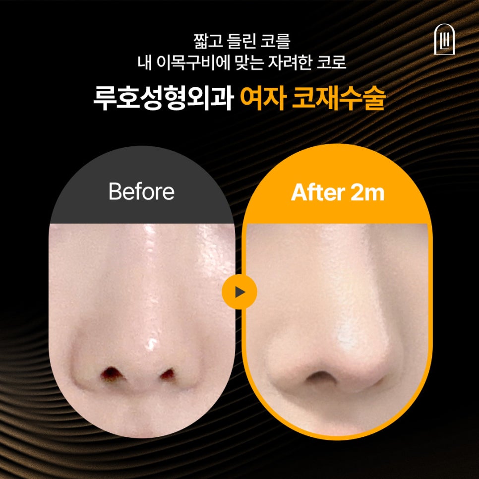 원인과 구조를 파악한 여자 코재수술 사례 살펴보기 관련 이미지 1