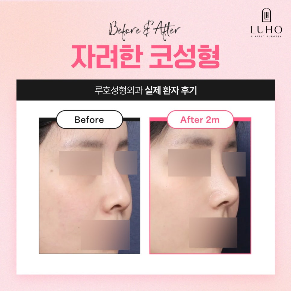 A Real Review of Nose Surgery at Luho Plastic Surgery, Customized to Fit My Face image 4