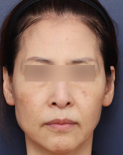 심부볼 처짐 고민 해결한 신사역 실리프팅 솔직 후기 관련 이미지 3