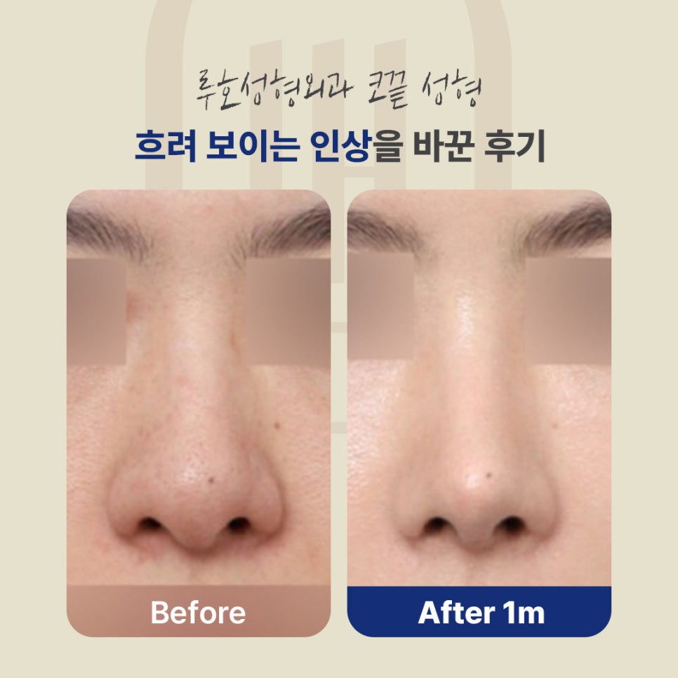 A Rhinoplasty Review for the Nasal Tip at Sinsa Station That Changed a Blurry Impression image 7