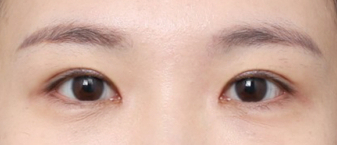 흐릿하던 속쌍, 신사역 쌍수자연유착으로 달라진 전후 관련 이미지 5