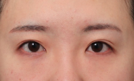A Case of Forehead Lift Surgery in Sinsa Station That Improved Both a Drooping Forehead and Eyebrows image 3