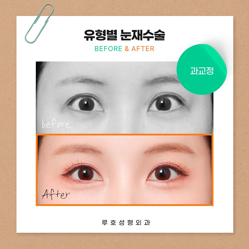 ［루호성형외과］유형별 눈재수술 관련 이미지 2