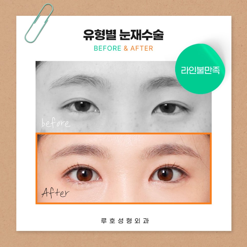 ［루호성형외과］유형별 눈재수술 관련 이미지 3