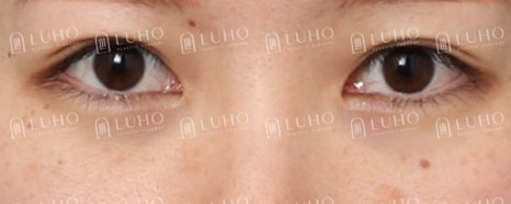 Improving an Eye Appearance That Had Lost Definition 8 Years After Buried-Suture Surgery image 4