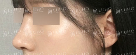 Before and After Gangnam Rhinoplasty for a Hump Nose: Refining the Prominent Hump for a New Look image 7