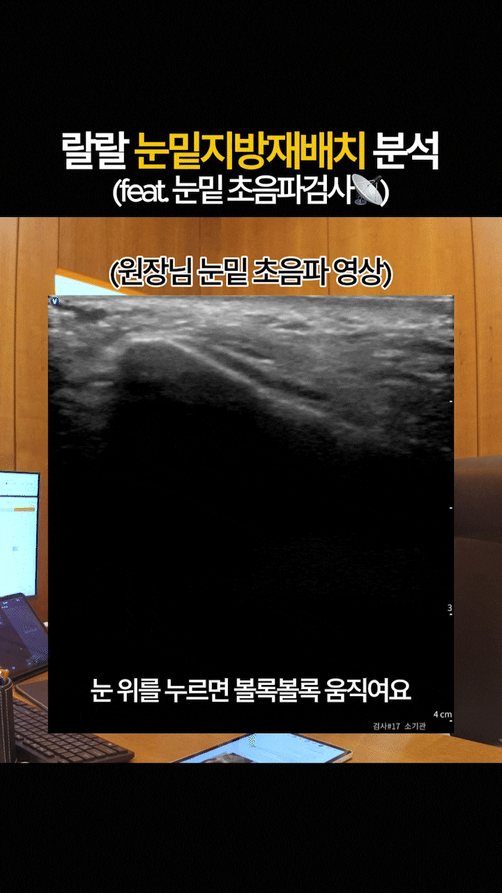 Sinsa Station Dark Circle Lower Eyelid Fat Repositioning: The Shadow Created by the Boundary Between the Under-Eye and Upper Cheek image 2