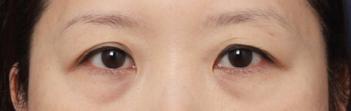 눈밑볼록, 신사역 눈밑지방재배치 받은 후기 관련 이미지 2