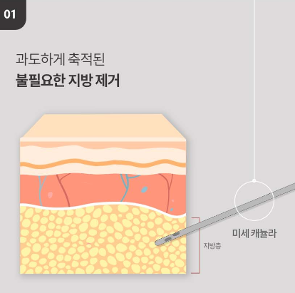 [Luho Plastic Surgery] High-Volume Half-Face Liposuction image 7
