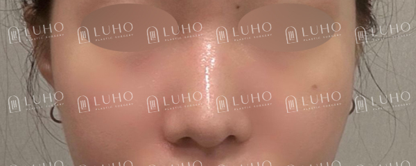 낮은 콧대와 둥근 코끝, 자연스럽게 정리한 코수술 전후 관련 이미지 3