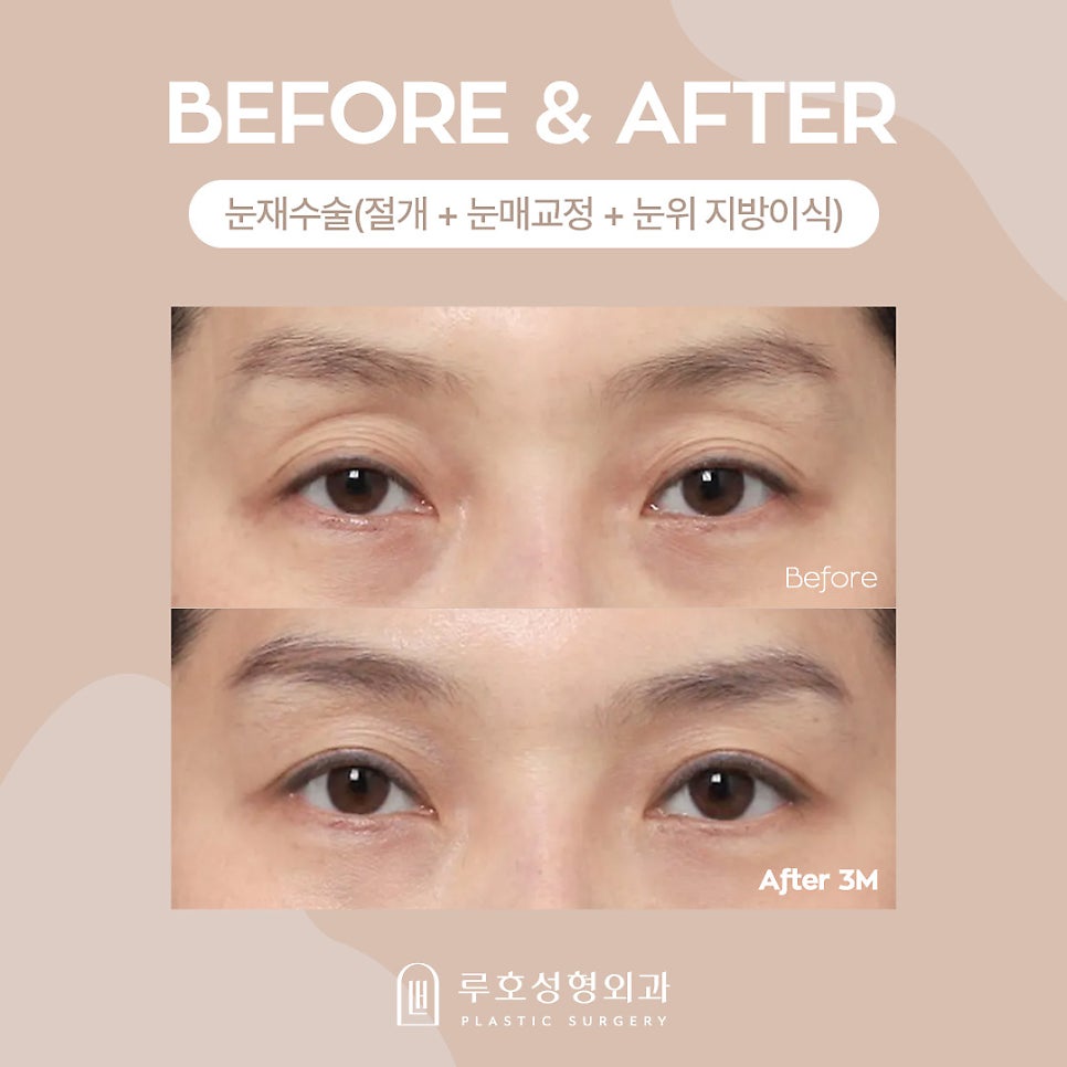 Middle-Aged Eye Surgery at Luho Plastic Surgery, Sinsa Station image 3
